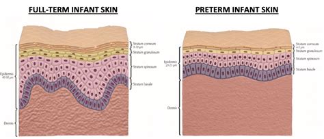 gelatenous skin premature baby|Biomarkers of neonatal skin barrier adaptation reveal  .